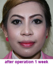 plastic_surgery_augmentation_rhinoplasty